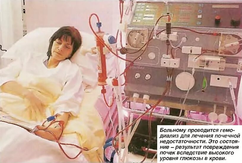 Показания к хроническому гемодиализу. Пациент с хронической почечной недостаточностью. Первый аппарат гемодиализа. Гемодиализ фистула гемодиализ. Сколько лет живут на диализе.
