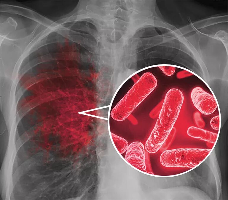 Туберкулез tuberculosis