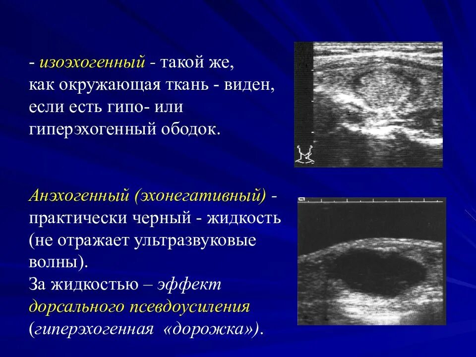 Образование без акустической тени. Изоэхогенный. Гиперэхогенные структуры. Анэхогенной структуры. Изоэхогенное образование.