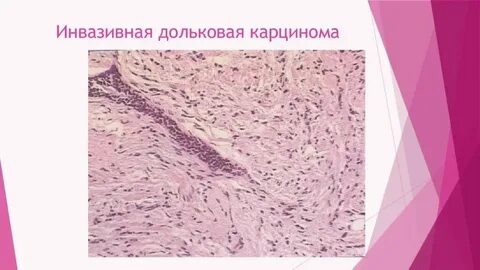 Инвазивная карцинома неспецифического типа что значит