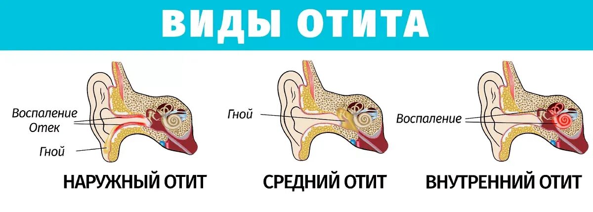 Внутреннее воспаление. Внутреннее воспаление