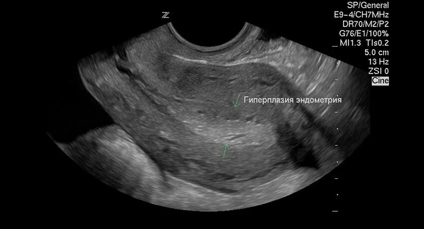 Эндометрия матки УЗИ гиперплазия эндометрия. Гиперпластические процессы эндометрия УЗИ. Гиперплазия эндометрия УЗИ картина. Гипоплазия эндометрия на УЗИ. Клиника эндометрия