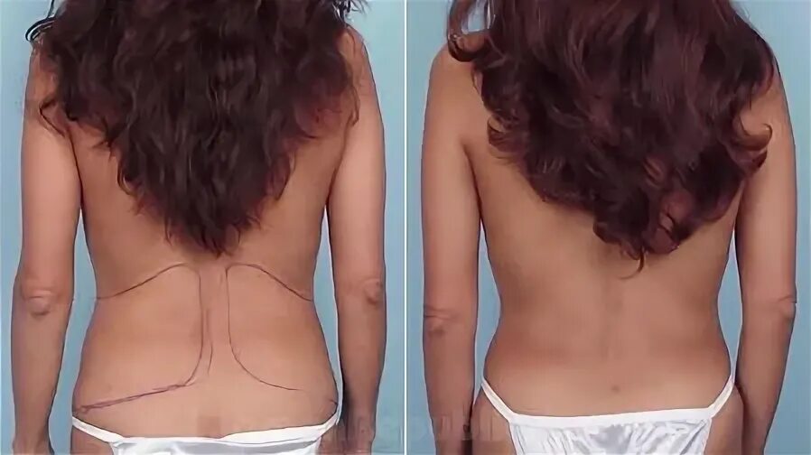 липосакция махачкала