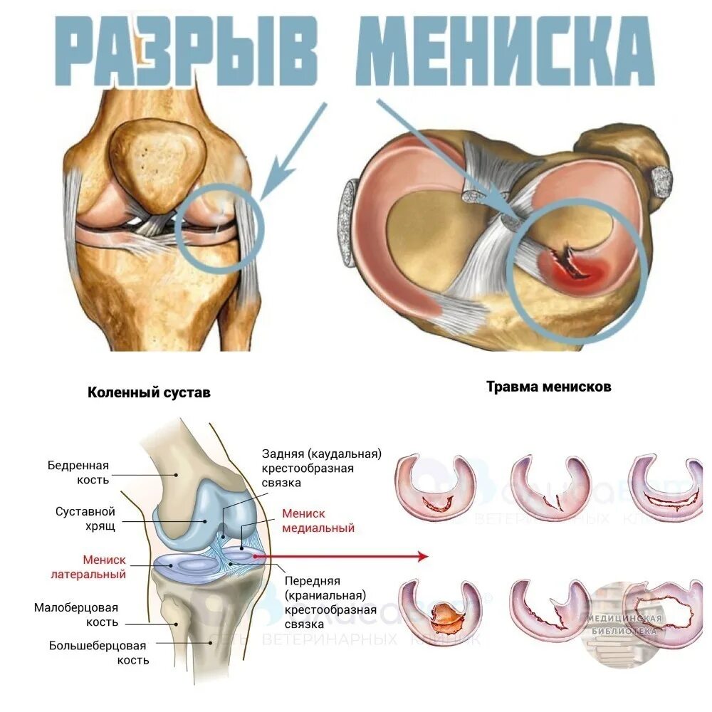 Связка мениска колена. Мениски колена анатомия. Строение колена мениск. Строение мениска коленного сустава анатомия.