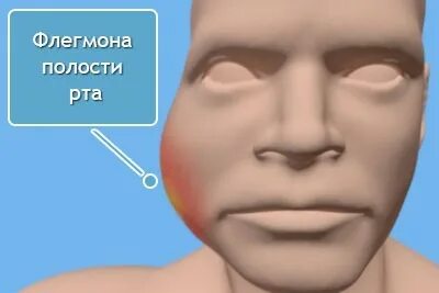 Флегмона новорожденных