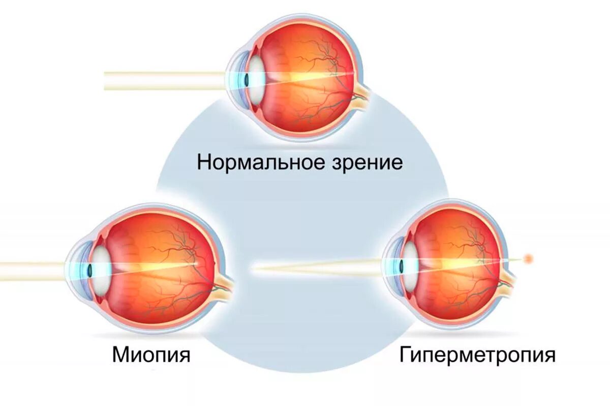 Близорукость первая помощь. Заболевания глаз близорукость и дальнозоркость. Строение глаза дальнозоркость. Дальнозоркость и близорукость строение глаза. Строение глаза человека близорукость и дальнозоркость.