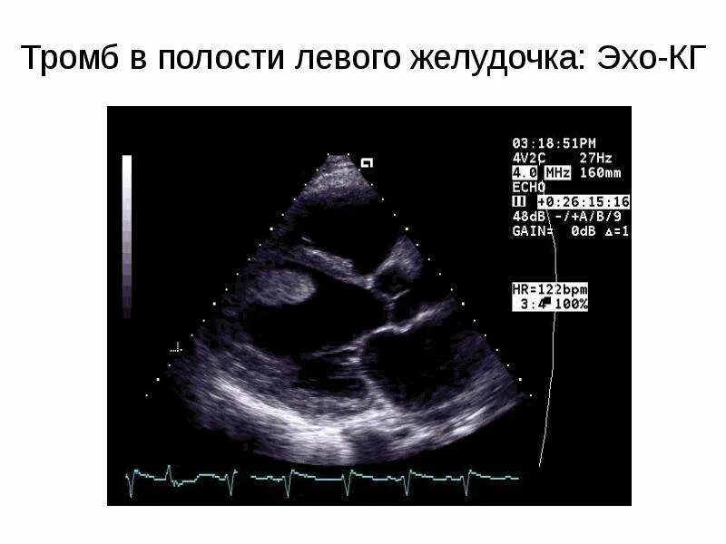 Тромбоз предсердий