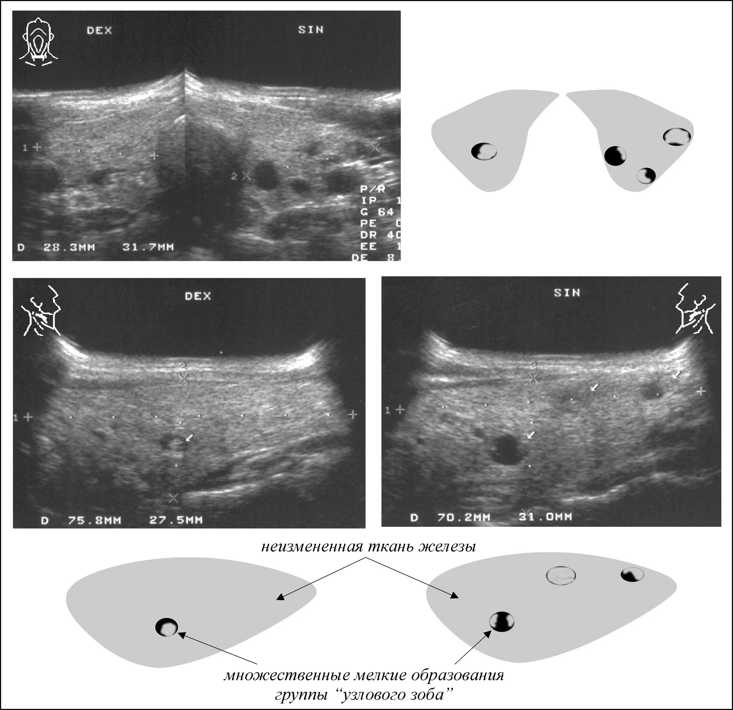 Диффузно атрофические изменения. Атрофический аутоиммунный тиреоидит. Многоузловой токсический зоб УЗИ. УЗИ картина узлового зоба. Подострый тиреоидит сцинтиграфия.