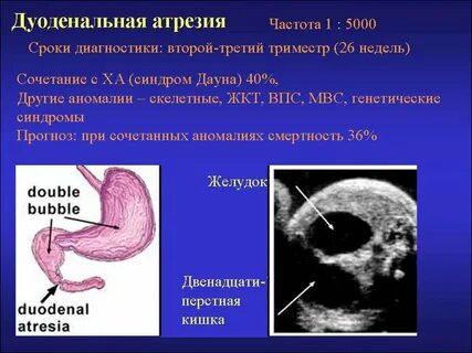 Атрезия пищевода мкб
