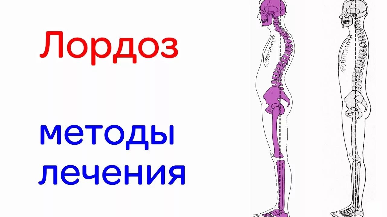 Лордоз симптомы. Лордоз как лечить. Лордоз грудного отдела кифоз поясничного. Лордоз как лечить. Лордоз усилен в поясничном отделе позвоночника.