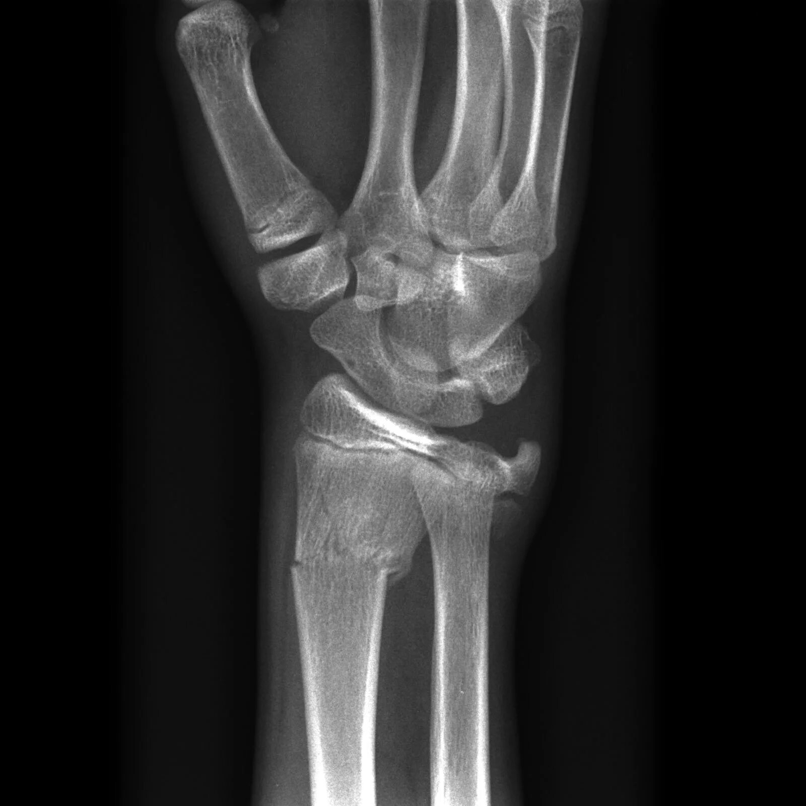 Radius fracture