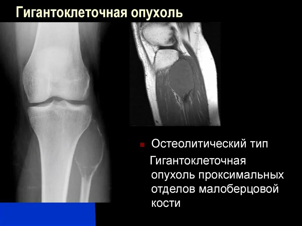 Гигантоклеточная опухоль лечение. Гигантоклеточная опухоль лечение. Гигантоклеточная опухоль лечение. Гигантоклеточная опухоль лечение. Злокачественная гигантоклеточная опухоль.