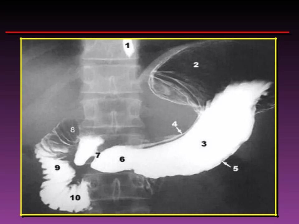 Стеноз кишечника что это. Пилорический отдел желудка рентген. Стеноз двенадцатиперстной кишки рентген. Луковица 12 перстной кишки рентген. Рентгеноскопия желудка и 12 перстной кишки.