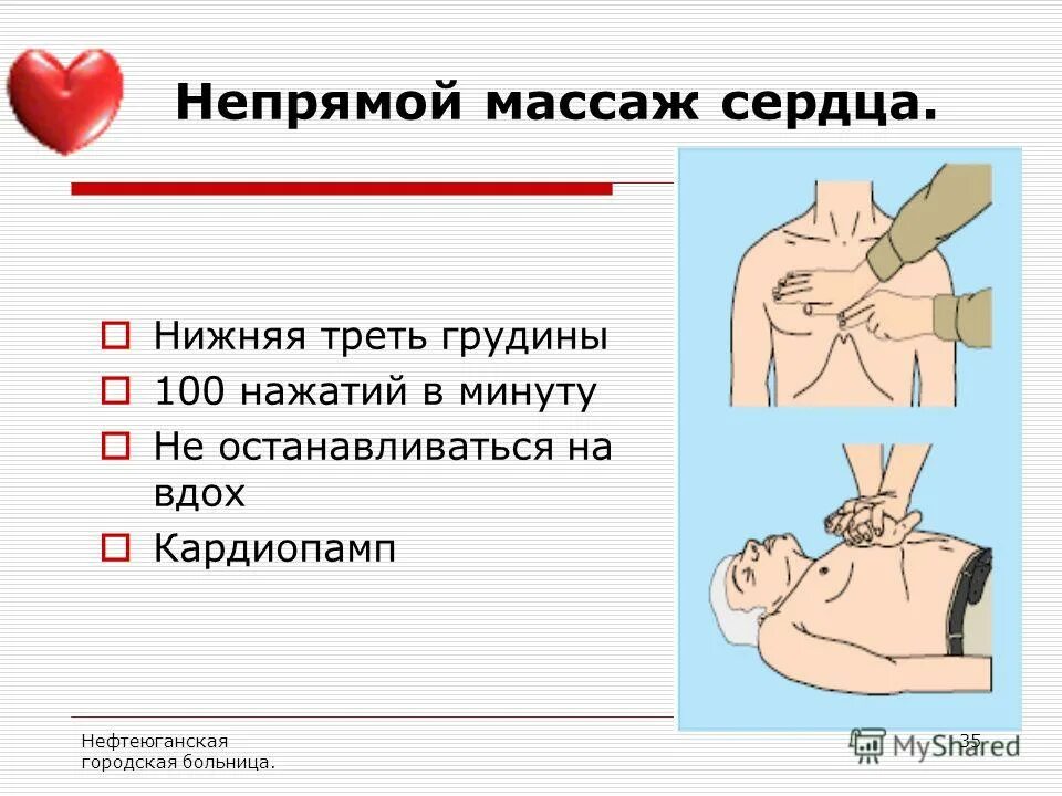 видео непрямого массажа сердца