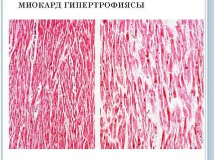 Гипертрофия препарат
