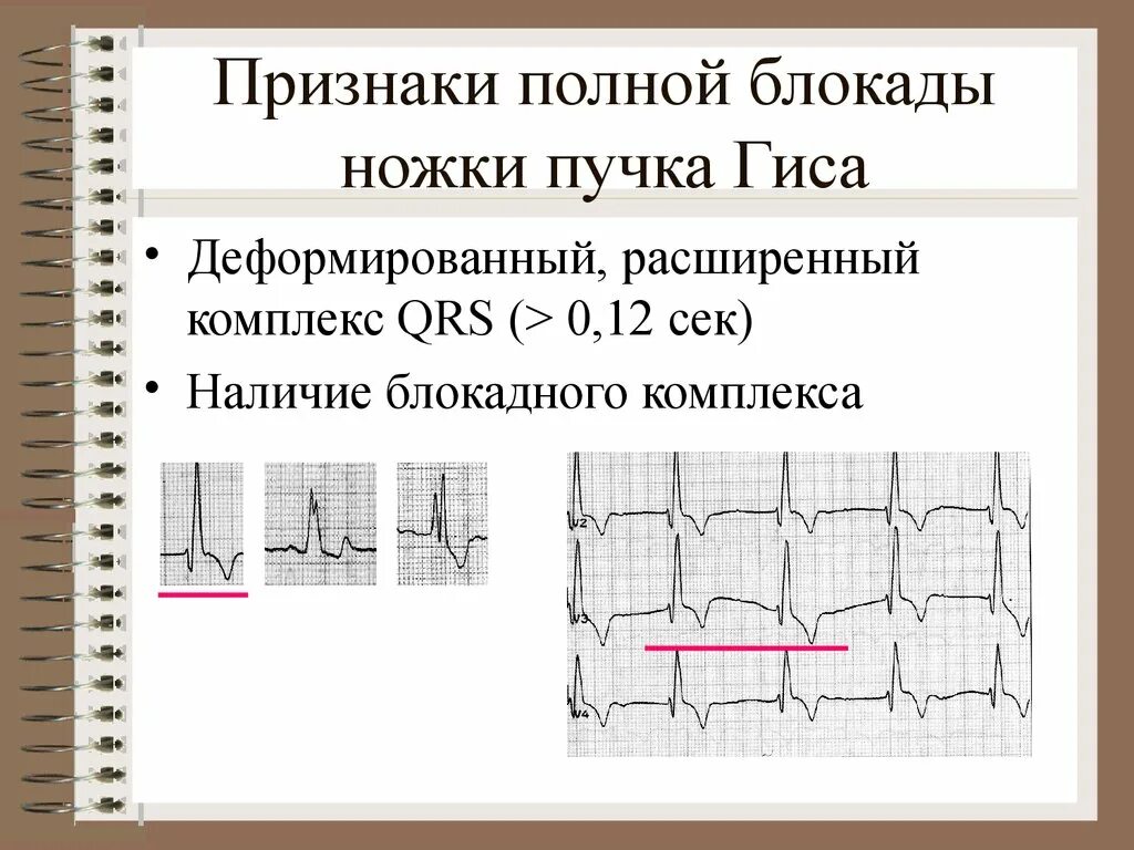 Блокада qrs. Деформированный комплекс QRS на ЭКГ. Блокада ножек пучка Гиса ЭКГ критерии. ЭКГ признаки блокады ножек пучка Гиса. Описание ЭКГ при блокаде правой ножки пучка Гиса.