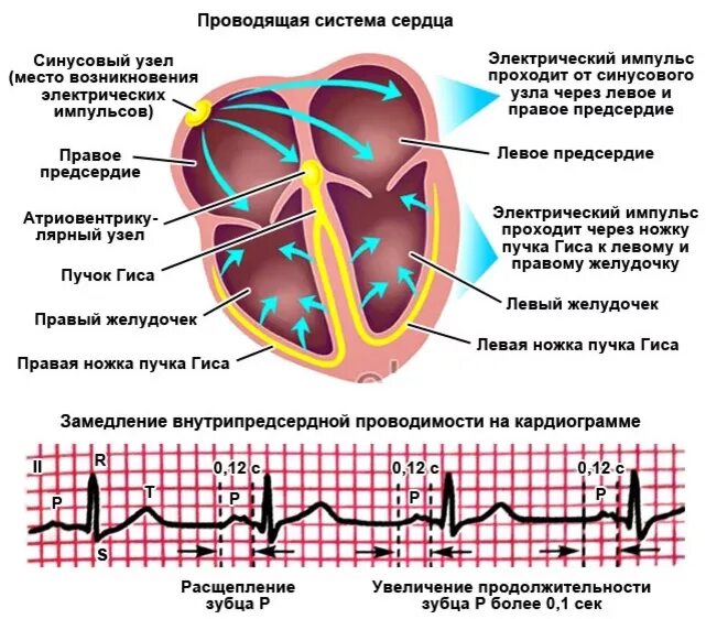 Блокада проводящей системы сердца ЭКГ. Проводящая система сердца синусовый узел. Нарушения проводимости сердца блокады ЭКГ. Нарушение внутрипредсердной проводимости на ЭКГ. Норма правого предсердия