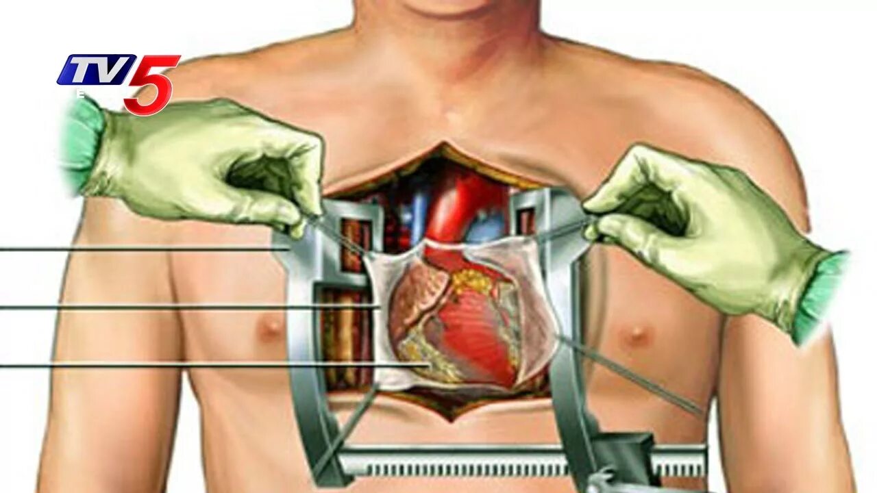 Полосная операция на сердце. Полостная операция на открытом сердце. После операции коронарного шунтирования