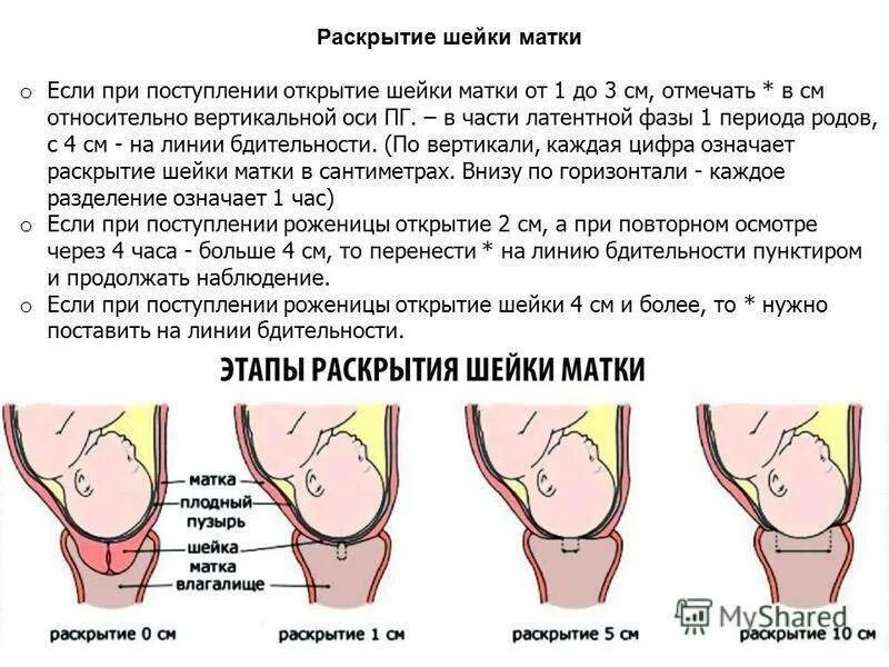 Матка 37 мм. Раскрытие шейки матки при беременности. Раскрытие шейки матки при родах периоды. Укороченная шейка матки при беременности 30 недель. Раскрытие шейки матки перед родами.