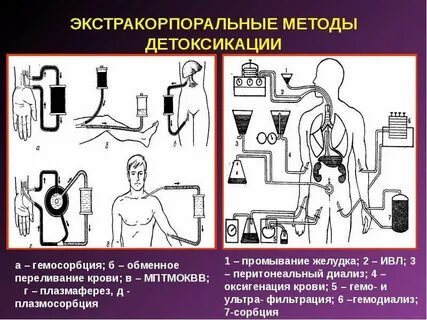 Экстракорпоральная терапия