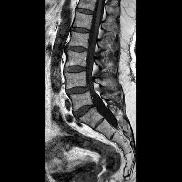 Стеноз позвоночного канала поясничного отдела мрт. Мрт пояснично-крестцового отдела позвоночника. Стеноз поясничного отдела мрт. Мрт пояснично-крестцового отдела позвоночника здорового человека.