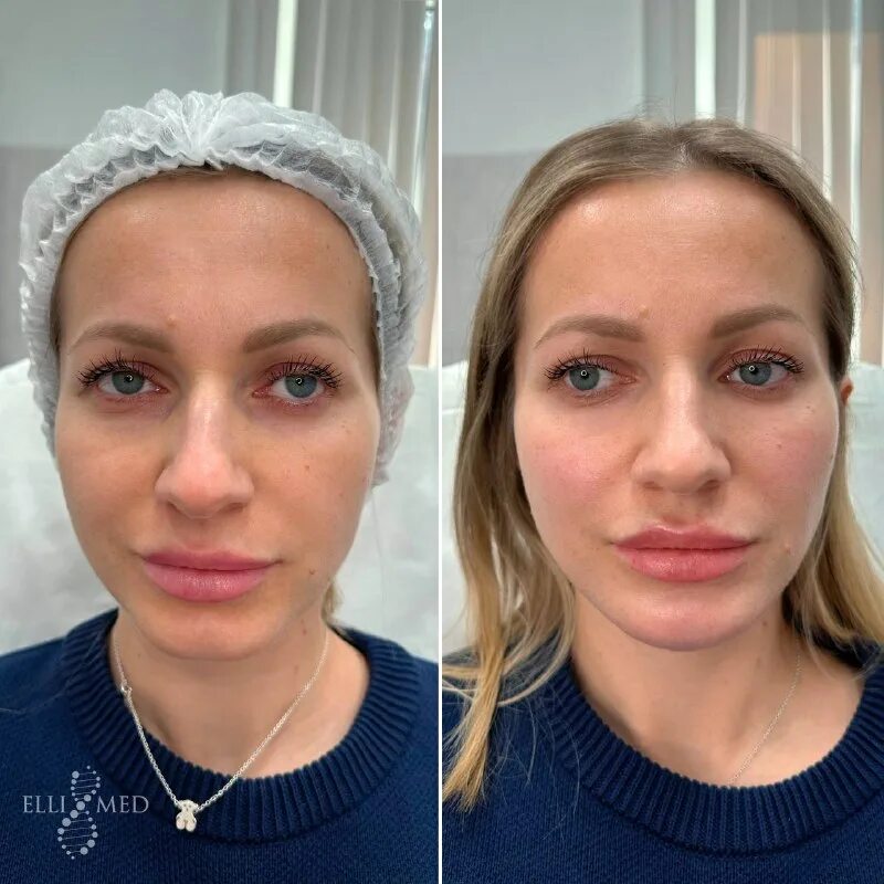 Radiesse векторный лифтинг до и после. подтянутые скулы. подтянутые скулы. подтянутые скулы. ботокс в скулы.