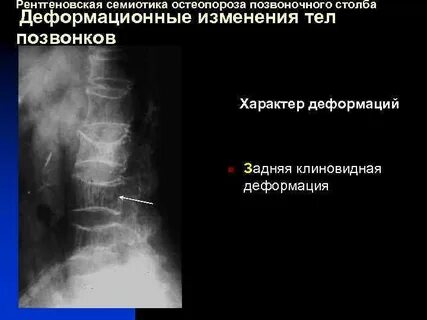 Клиновидная деформация позвонков th 12