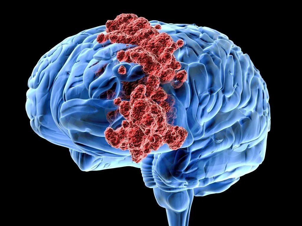 Опухоль мозга глиобластома. Злокачественная глиома головного мозга. Злокачественное новообразование головного мозга. Раковые заболевания головного мозга. Опухоли мозга неврология