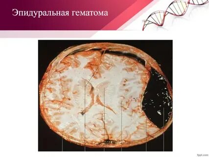Кровоизлияние живота