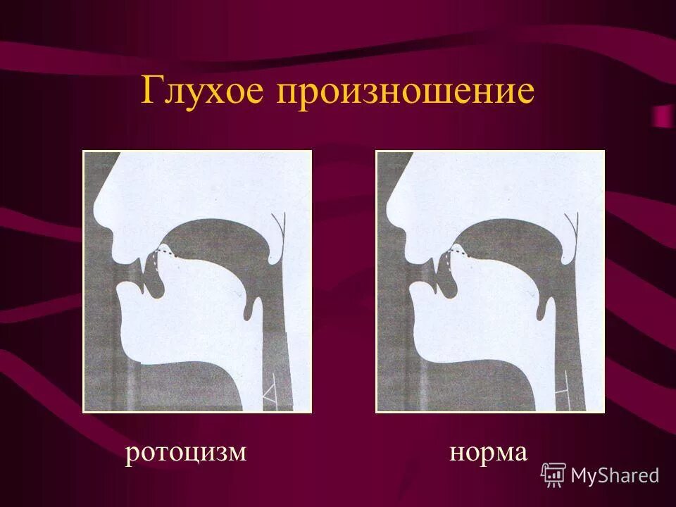 Место артикуляции. Горловое произношение буквы р. Увулярное произношение звука р. Схема звука р. Положение языка при произношении звука р.