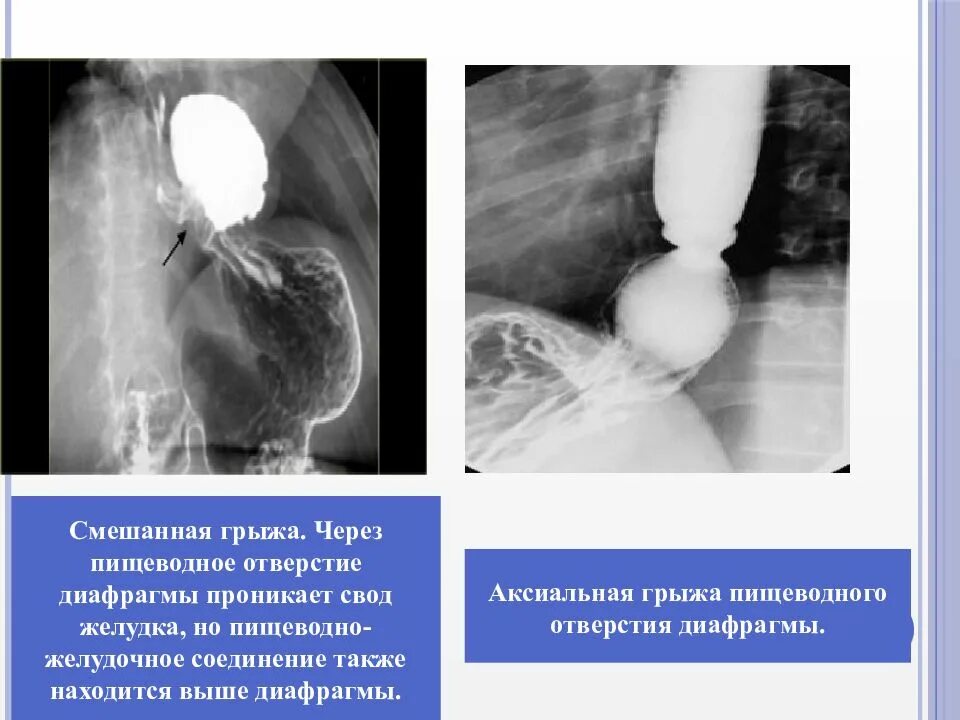 Скользящая грыжа пищеводного отверстия диафрагмы рентген. Грыжа пищеводного отверстия диафрагмы рентген классификация. Аксиальная грыжа пищеводного отверстия. Аксиальная диафрагмальная грыжа.