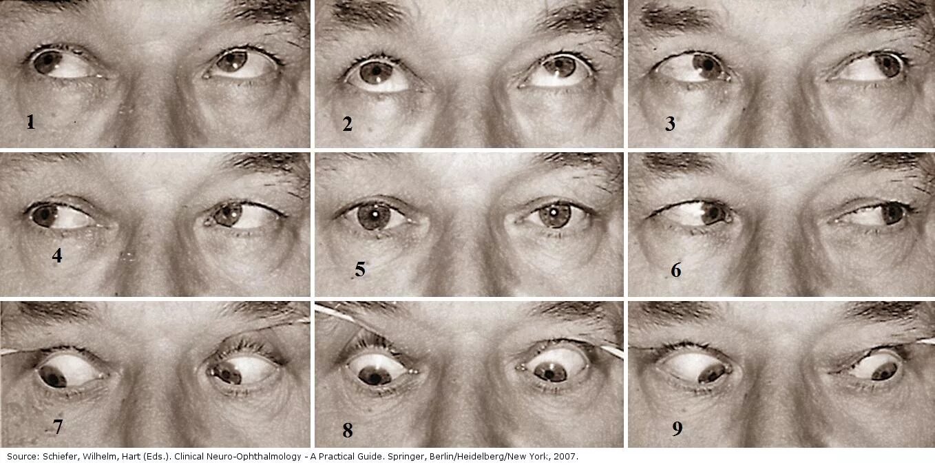 Нарушение движения глаз. Нистагм глазного яблока. Движение глазных яблок. Подвижность глазных яблок. Объем движений глазных яблок.