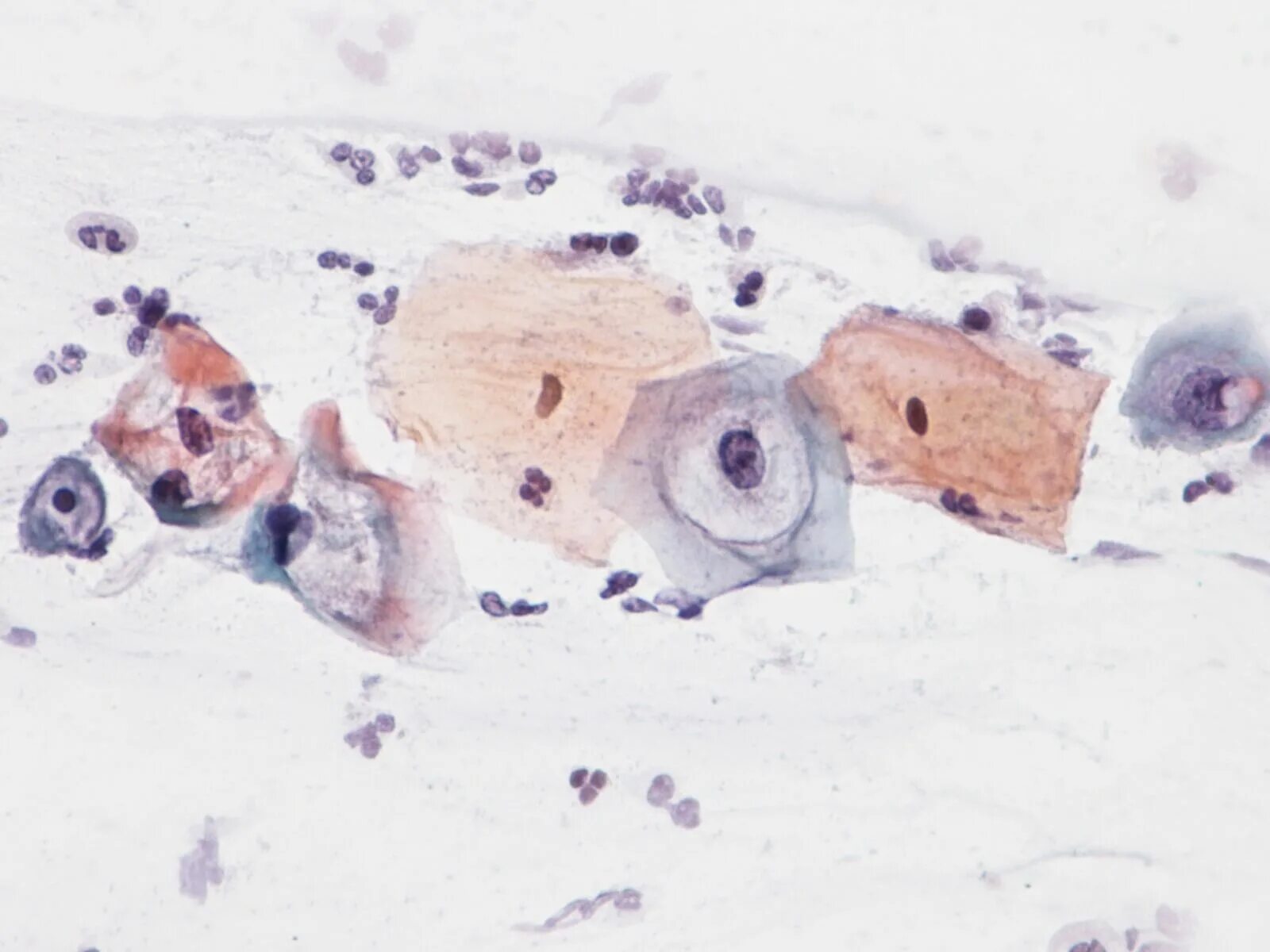 Атипичные клетки под микроскопом. Атипические клетки в мазке. Атипия предрака клетка под микроскопом. Атипия под микроскопом.