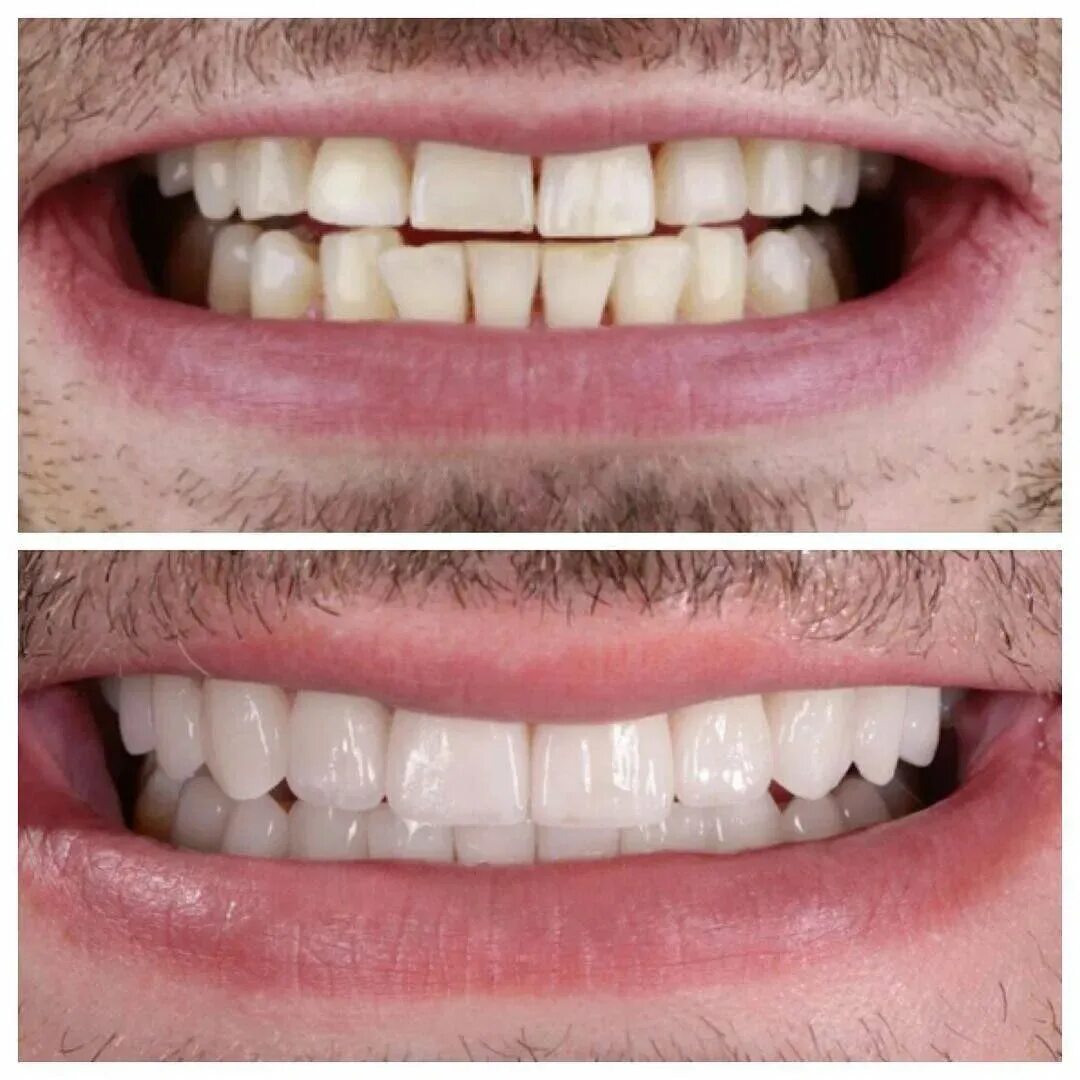 наращивание зубов пломбировочным материалом. строение челюсти и зубов человека название зубов. керамический винир на передний зуб. народещеные передние зубы. глазной зуб.