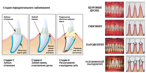 Классификация пародонта. Заболевания пародонта схема. болезни пародонта гингивит пародонтит пародонтоз. пародонтит воспаление десны у зуба.
