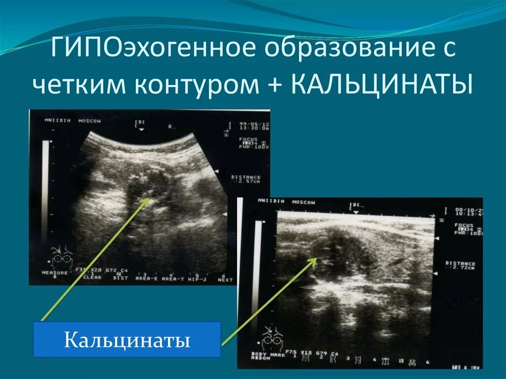 Гипоэхогенное округлое образование. Гипоэхогенное образование щитовидной железы. Узлы щитовидной железы на УЗИ. Гипоэхогенные структуры.