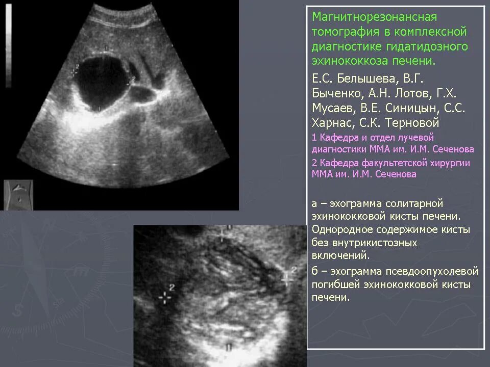 Кисты печени симптомы причины. Эхинококкоз печени альвеококкоз печени УЗИ. Стадии эхинококковой кисты на УЗИ. Эхинококковая киста печени протокол УЗИ. Эхинококковая киста печени УЗИ.