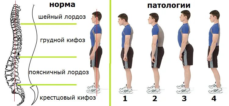 Нормальная поясница. Кифоз и лордоз поясничного отдела. Лордоз поясничного отдела угол в норме. Лордоз грудного отдела кифоз поясничного. Отделы позвоночника лордоз кифоз.