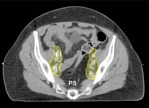 Мезоректальные лимфоузлы мрт. Лимфатические узлы кт анатомия. Лимфатические узлы малого таза у женщин мрт. Лимфатические узлы малого таза у женщин схема. Тазовые лимфатические узлы кт.