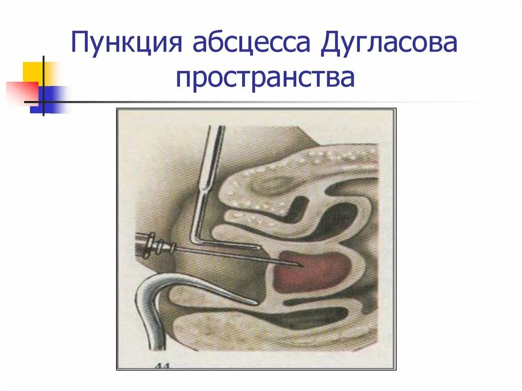 Пункция дугласова пространства. Пункция дугласова пространства техника. Диагностическая пункция абсцесса. Пункция дугласова пространства инструменты. Пункция через задний свод