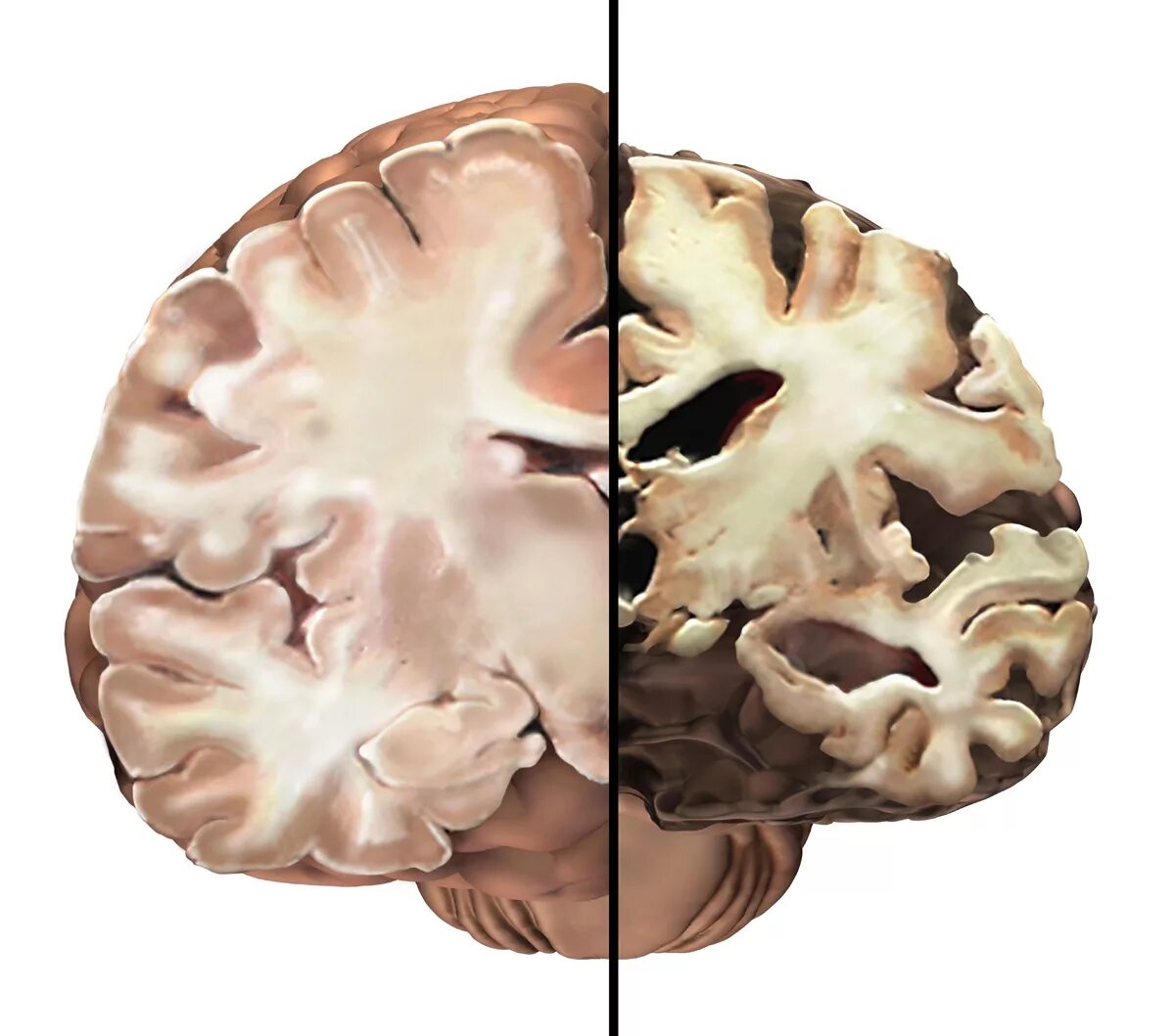 Болезнь заболевание мозга. Сенильная деменция головного мозга. Болезнь Альцгеймера. Атрофические изменения коры головного мозга. Атрофия коры головного мозга.