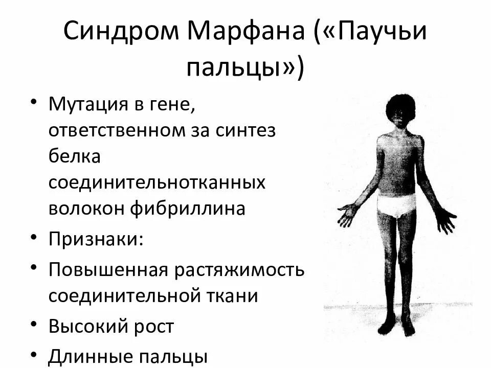 Синдром толоса. Синдром марфана генетика. болезнь марфана клинические проявления. симптомокомплекс синдрома марфана.