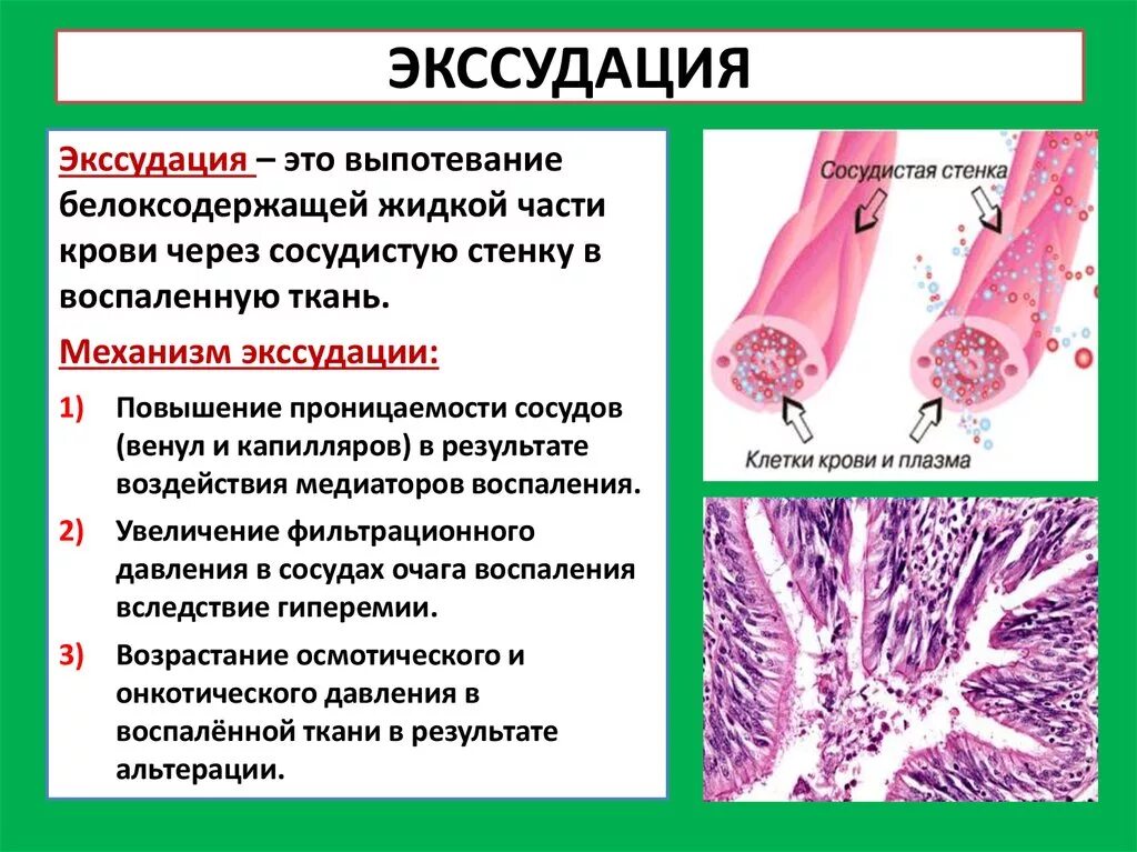 Экссудация это в патологии воспаления. Экссудация воспаление механизм. Воспаление альтерация экссудация пролиферация. Экссудация гистология. Экссудация возникает вследствие