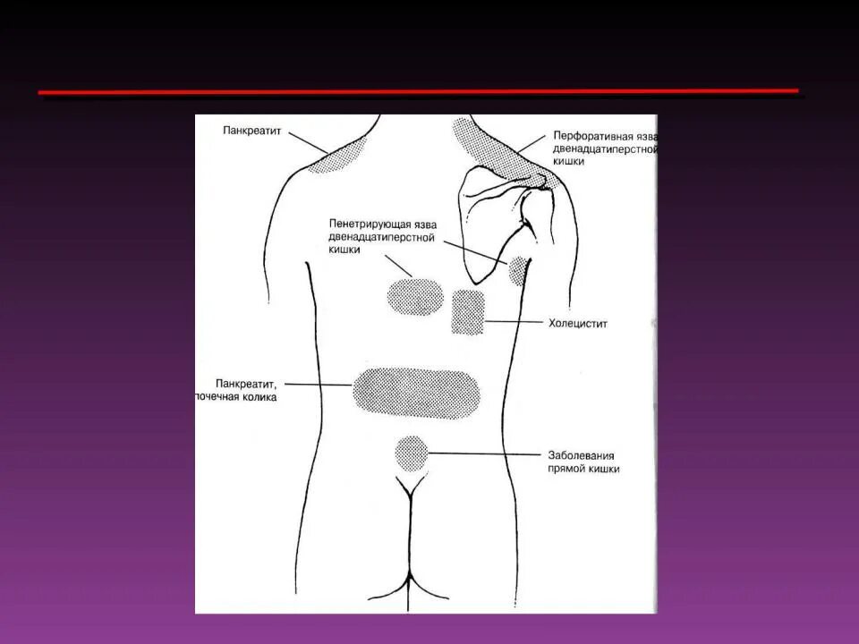 Локализация абдоминальной боли. Иррадиация абдоминальной боли. Локализация боли при заболеваниях. Заболевания локализация боли