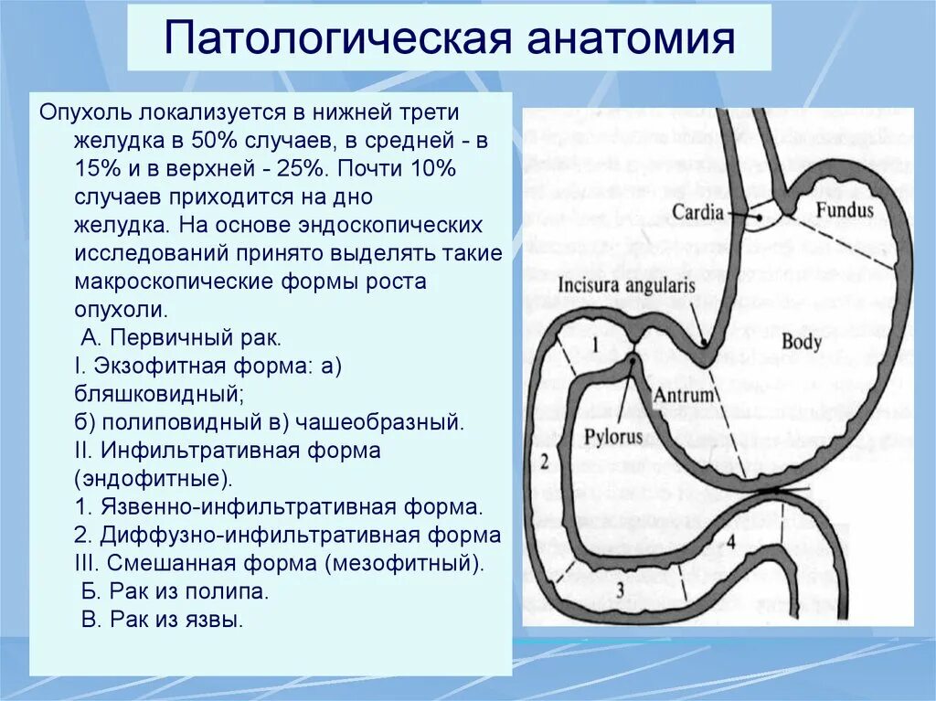 Злокачественная опухоль желудка. Злокачественное новообразование тела желудка. Образование тела желудка. Локализация опухоли желудка. Опухоли желудка классификация.
