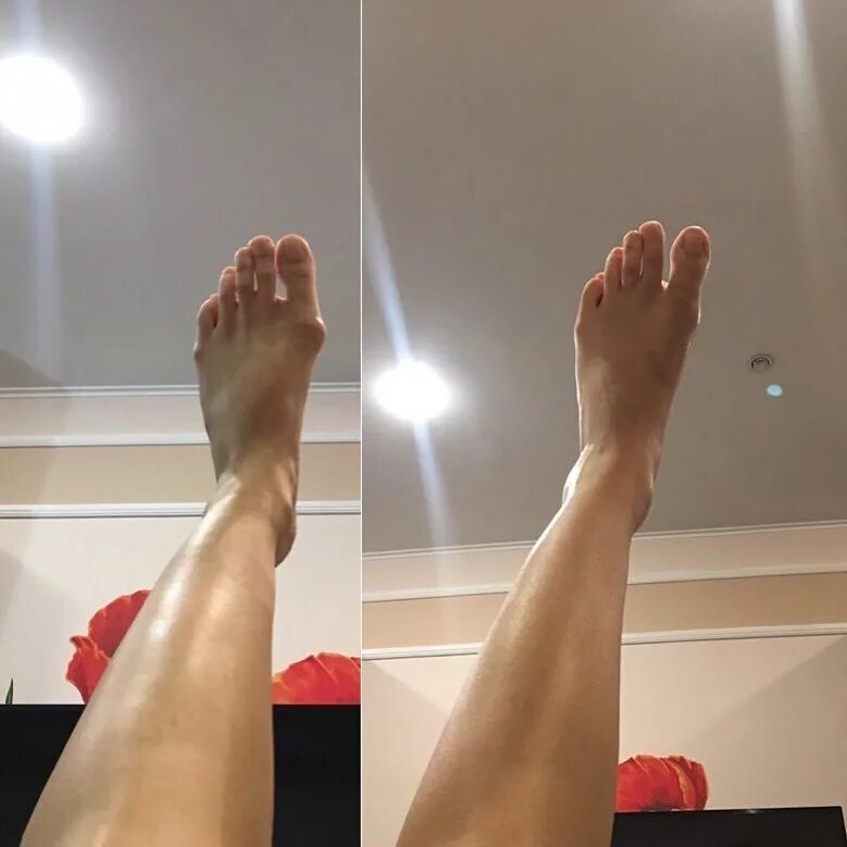 Выпрямление большого пальца на ноге. Как выпрямить большой палец на ноге. Как выпрямить большой палец на ноге. Для выправления косточки на ноге. Носки для hallux valgus.