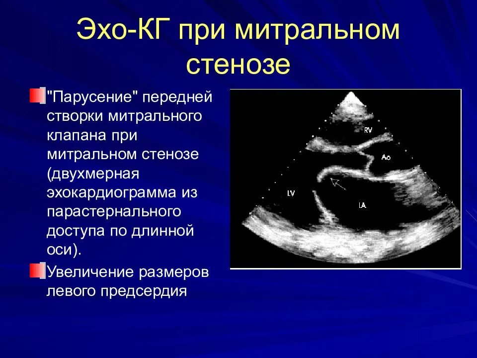 Эхо-кг при стенозе митрального клапана. Аортальный стеноз эхокардиография. Эхокардиограмма митральный стеноз. Стеноз аортального клапана эхокардиография. Митральный стеноз признаки