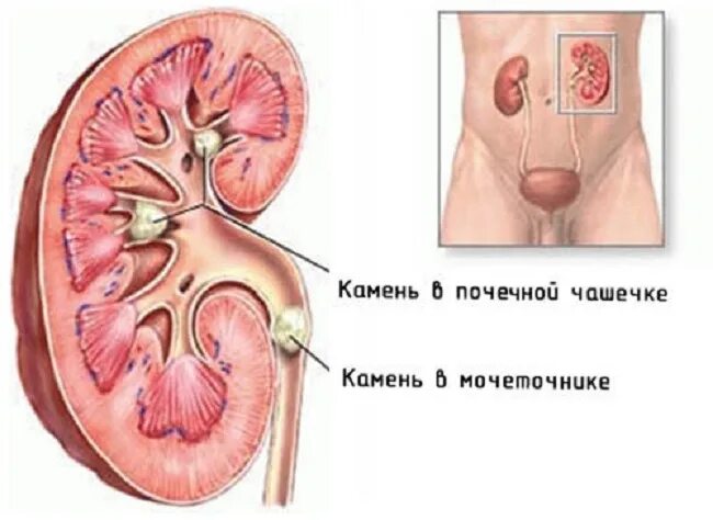 Как снять боли в почках домашних условиях Болят почки какие таблетки принимать найдено 88 фотографий
