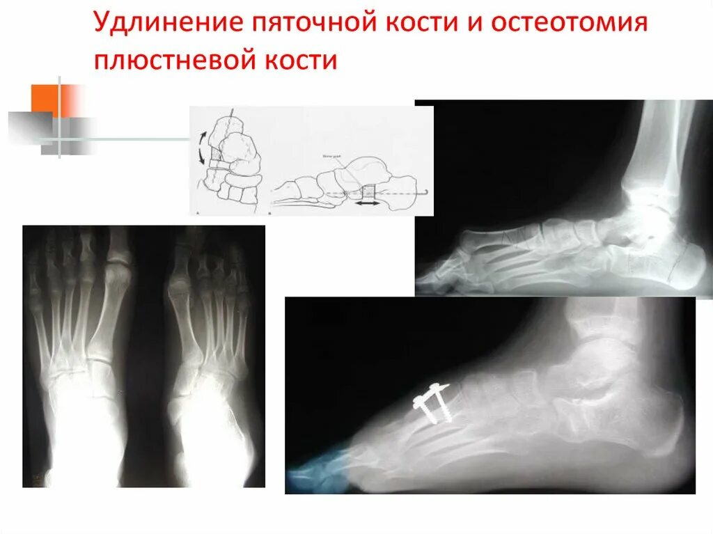 Пяточная остеотомия. Корригирующая остеотомия пяточной кости. медиализирующая остеотомия. медиализирующая остеотомия пяточной кости. удлиняющая остеотомия пяточной кости.