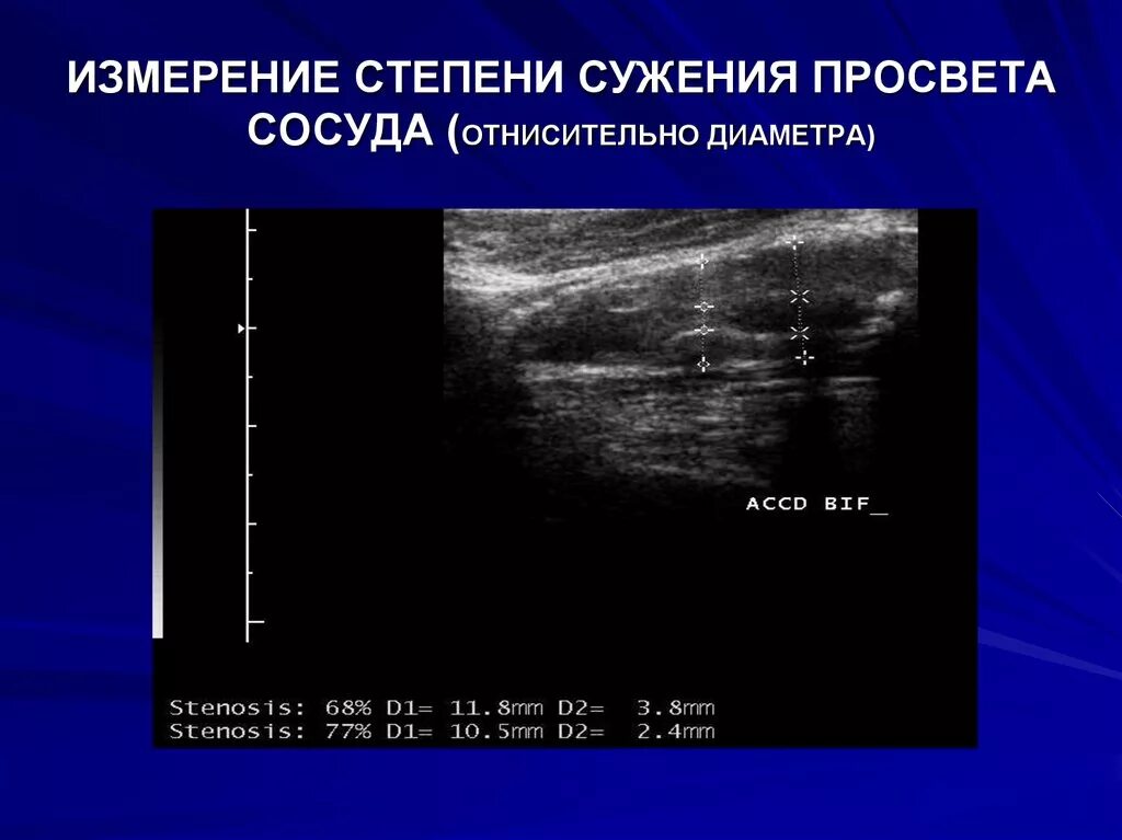 Процент стеноза сосудов. Стеноз сонных артерий на УЗИ. Степени сужения артерий. Стенозирование просвета сосуда. Сужение просвета артерии.